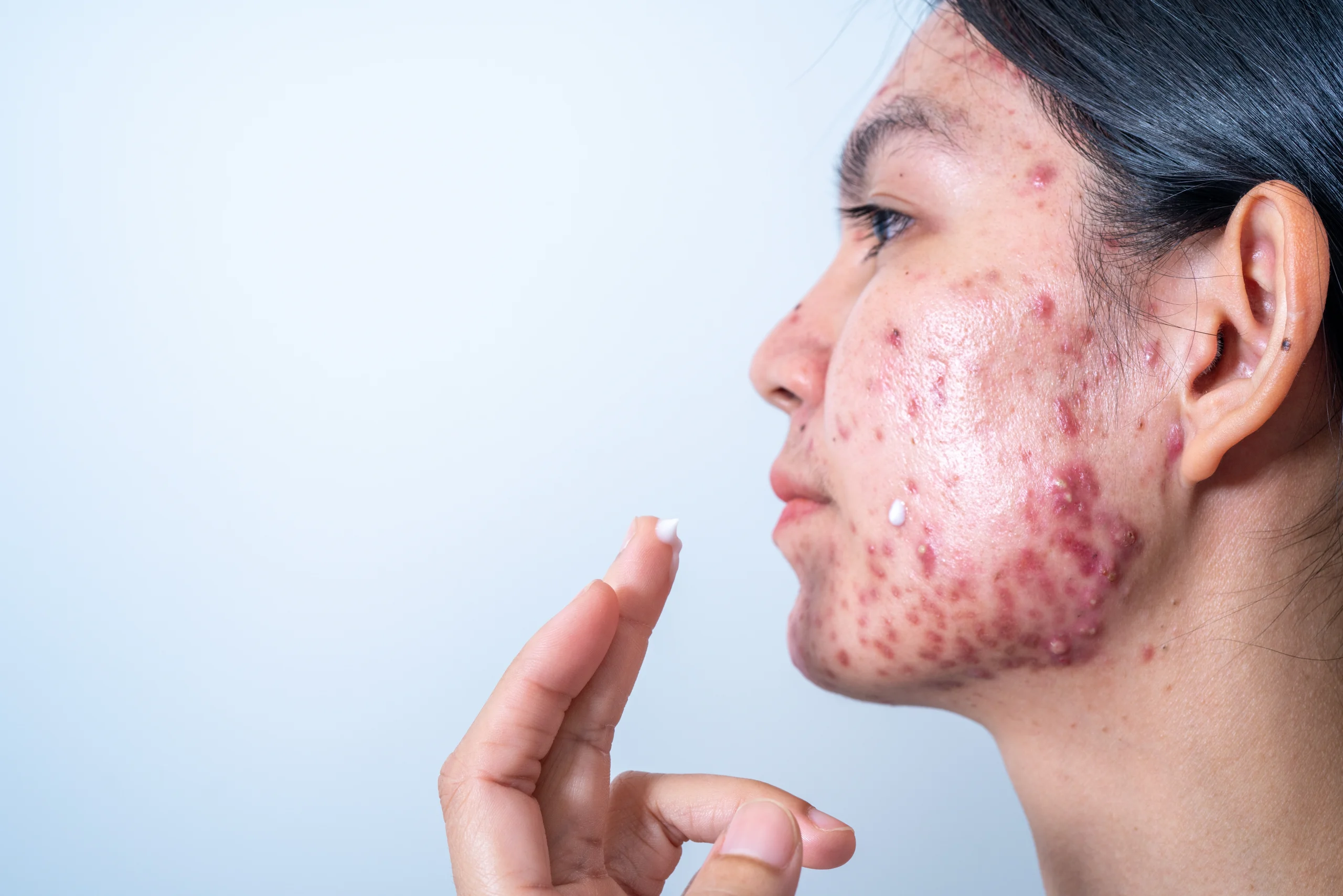 Professional acne treatment in Abu Dhabi at First City Medical Center dermatology clinic
