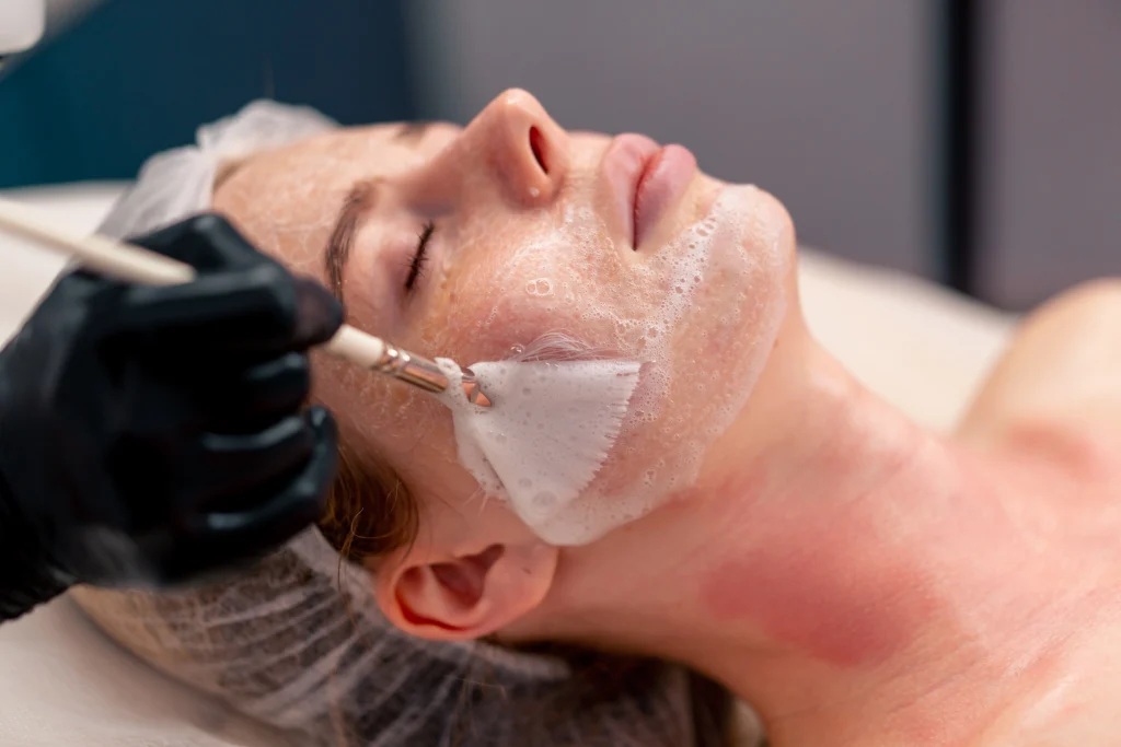 Chemical peel treatment in Abu Dhabi at First City Medical Center