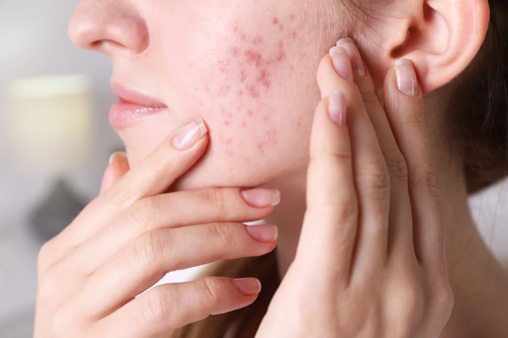 Acne scars and acne marks treatment in Abu Dhabi