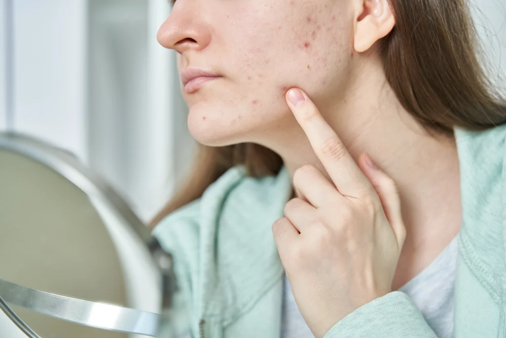 Acne treatment in Abu Dhabi at First City Medical Center